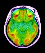 Normal brain blood flow,MRI and SPECT
