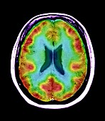 Normal brain blood flow,MRI and SPECT