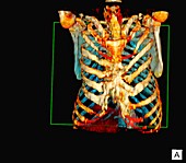 Sunken chest,3D CT scan