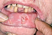 Ulcerated lip from repeated chewing