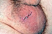 Epididymal cyst removal scar