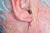 Ear after skin cancer removal