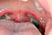 Throat after tonsil removal