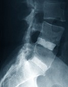 Spinal fusion for slipped discs,X-ray