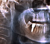 Dental implant,X-ray
