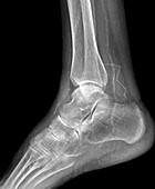Calcified ankle arteries,X-ray