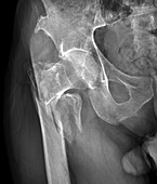 Fractured hip,X-ray