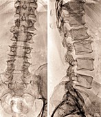 Spinal stenosis after surgery,X-ray