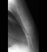 Secondary bone cancer,X-ray