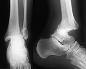 Fractured ankle,X-ray