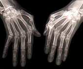 Rheumatoid arthritis of the hands,X-ray