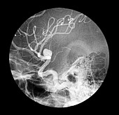 Brain aneurysm,X-ray