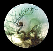 Brain aneurysm,X-ray