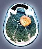 Brain tumour,CT scan