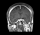 Pachymeningitis,MRI