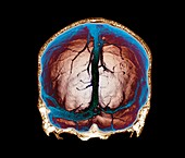 Thrombophlebitis of the brain,3D CT scan