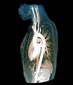 Takayasu's arteritis,MRI scan