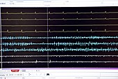 Heart surgery electrophysiology screen