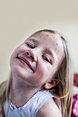 Girl with chickenpox