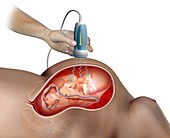 Foetal ultrasound scan,illustration