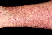 Bullous pemphigoid