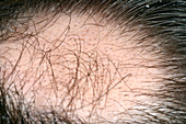 Hair loss