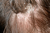 Dandruff in seborrheic dermatitis