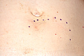Treatment markings for uterine fibroids