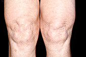 Swollen knees in polyarthritis