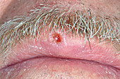 Squamous-cell carcinoma skin cancer