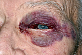 Subconjunctival haemorrhage after fall