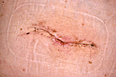 Incisional hernia after removal
