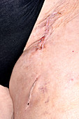 Endarterectomy wound