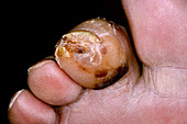Infected toe injury in diabetic