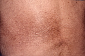 Skin colouration after shingles rash