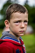 Boy with hay fever allergic reaction