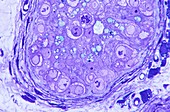 Human testis cancer,light micrograph
