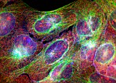 Osteosarcoma cells,light micrograph