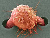 Breast cancer cell,SEM