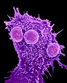 Cancer cell and T lymphocytes,SEM