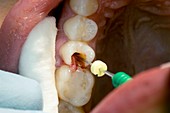 Root canal dental surgery
