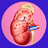 Kidney in renal hypertension,artwork