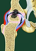 Avascular hip necrosis,illustration