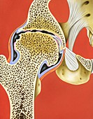 Hip joint pannus formation,illustration