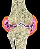 Rheumatoid arthritis,illustration
