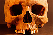 Skull from Murecine hotel,Pompeii