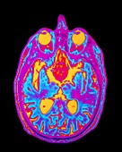 Coloured MRI brain scan: pituitary adenoma