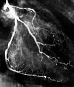 Narrowed coronary arteries,X-ray