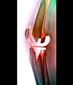 Prosthetic knee joint,X-ray