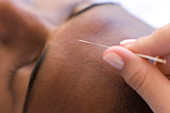 Acupuncture